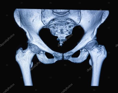 MRI scan of the hip joint — Stock Photo © Andregric #71883119