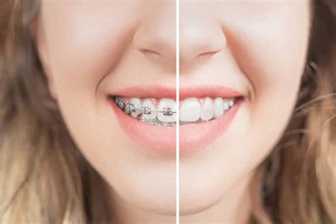 Before and After Braces | Orthodontic Services | Johns Creek GA