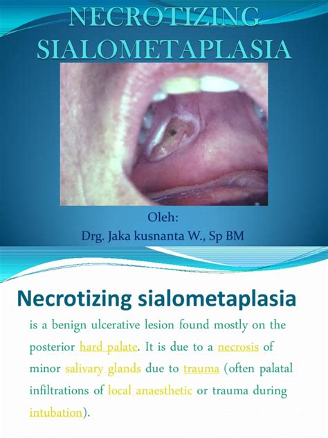 Necrotizing Sialometaplasia | PDF | Necrosis | Biopsy