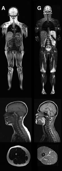 Congenital generalized lipodystrophy - wikidoc