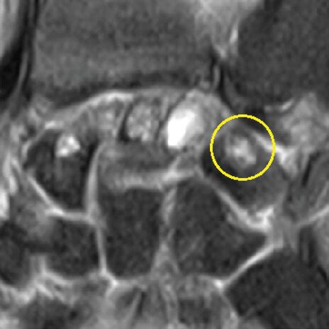 MRI of the left wrist showing IGC (from (a) to (b)) in the scaphoid,... | Download Scientific ...