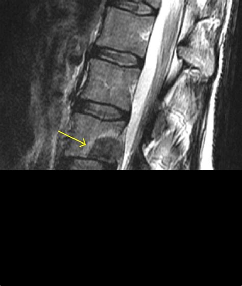 Targeted Radiation Reduces Pain from Cancer Metastases in the Spine ...