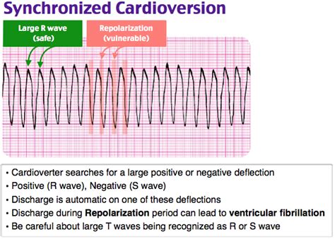 synchronized cardioversion - Google Search in 2020 | Emergency medicine, Cardiac nursing, Ekg ...