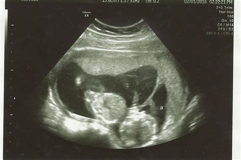 Did You Find Out It Was Twins At A Later Ultrasound? | Twiniversity #1 Parenting Twins Site