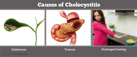 Cholecystitis | Inflammation of the Gall Bladder - Causes, Symptoms, Treatment, Diagnosis and ...