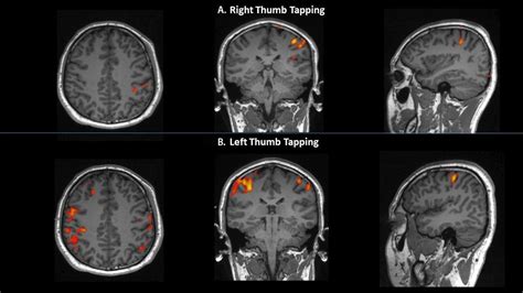 Bilateral Motor Cortex Control for Left Thumb Movement: An Incidental ...