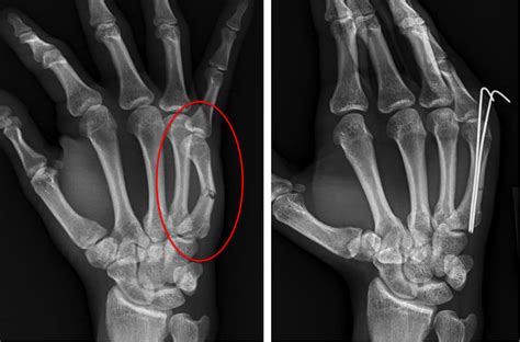 Hand Fracture - Raleigh Hand Surgery — Joseph J. Schreiber, MD