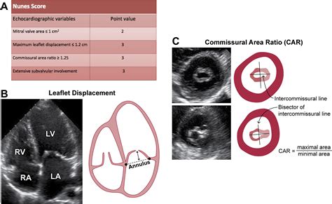 Advances in Rheumatic Mitral Stenosis: Echocardiographic, Pathophysiologic, and Hemodynamic ...