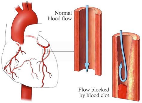 10 Signs of Blood Clot in Heart