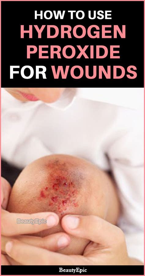 How to Treat Wounds With Hydrogen Peroxide? | Hydrogen peroxide, Wounds ...