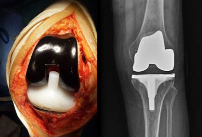 Best orthopedic hospital in chennai | Oxinium (Ceramic) Knees