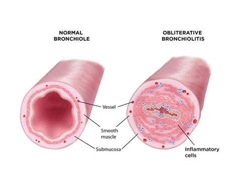 Developing a novel inhaled therapeutic for the treatment of bronchiolitis obliterans syndrome ...