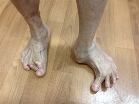 Foot Deformities Singapore|Surgery Reconstruction|Correction