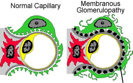 Understanding Membranous nephropathy