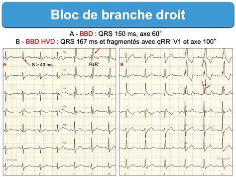 Bloc de branche 2. droit complet : e-cardiogram