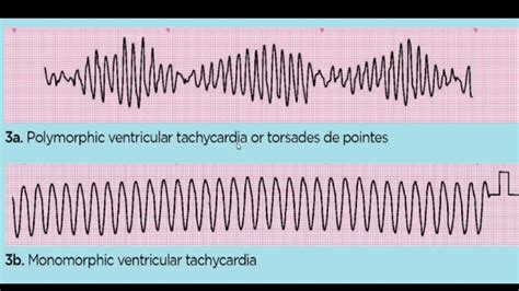 Monomorphic And Polymorphic Ventricular Tachycardia