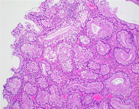 Thyroid Adenoma Histology