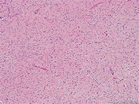 Neurofibroma