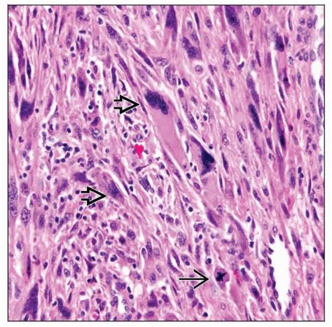 Histiocytoma Histology