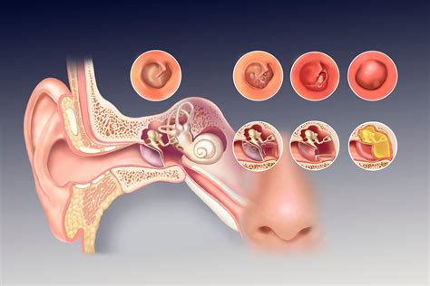 perforated eardrum Archives - Jackie Heda | Biomedical & Scientific Visuals