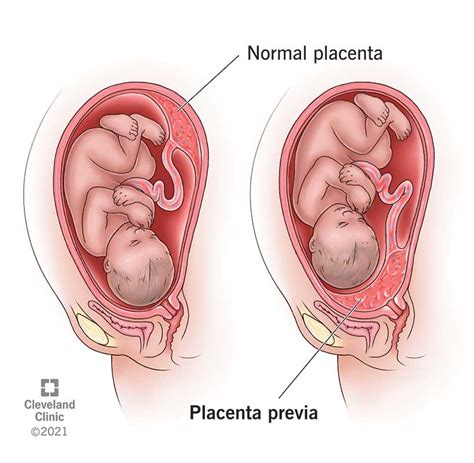 Placenta - NaythanDilek