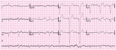 Atrial Fib Ecg