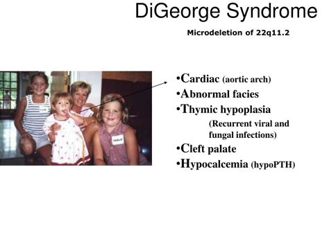 PPT - DiGeorge Syndrome PowerPoint Presentation, free download - ID:6701540