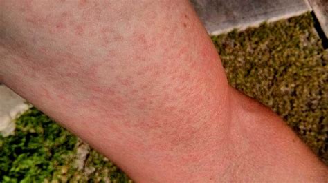 Zika Rash: Symptoms, Treatment, and More