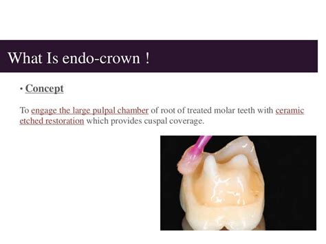 Endo crown