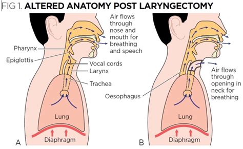 Tracheostomy 4: supporting patients following a laryngectomy | Nursing ...