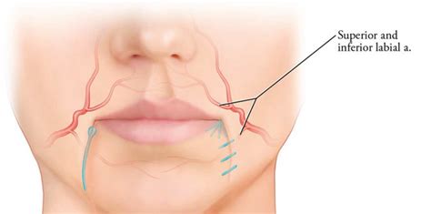 Unit 13: Lip Rejuvenation – Vindoc Training