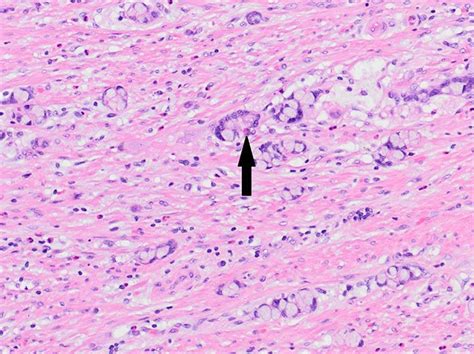 Goblet cell adenocarcinoma. This lesion shows the typical nests of ...