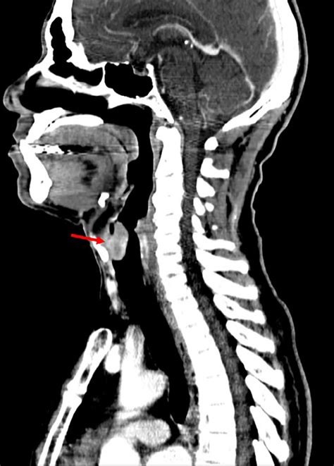 Sagittal CT of the neck demonstrates the 2.5-cm oval-enhancing mass ...