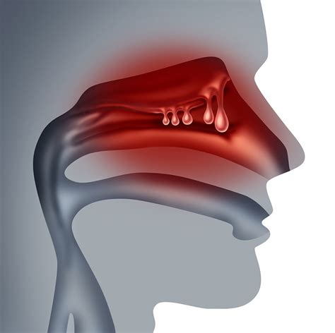 Nasal Polyp Complications | Puget Sound Sinus Center