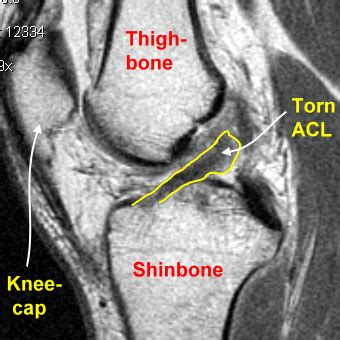 Anterior Cruciate Ligament Reconstruction | Orlin Cohen