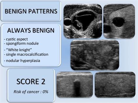 Αποτέλεσμα εικόνας για spongiform nodule thyroid ultrasound | Thyroid ultrasound, Ultrasound ...