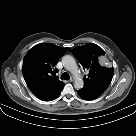 Squamous cell carcinoma of the lung CT scan - wikidoc