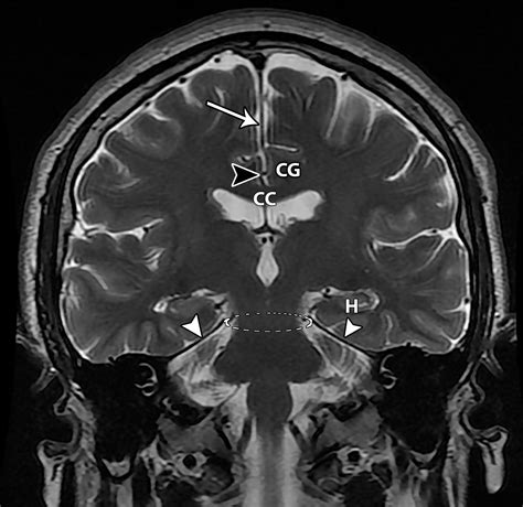 Types of Cerebral Herniation and Their Imaging Features | RadioGraphics