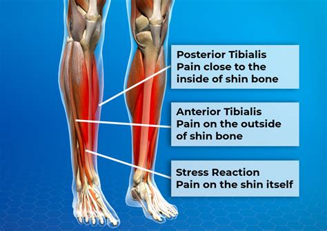 How to Get Rid of Shin Splints: Treat and Fully Recover