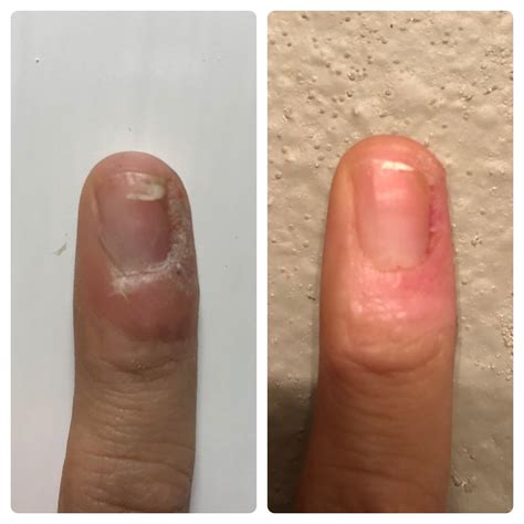 4 weeks after Candida injections the difference is amazing. : r/Warts