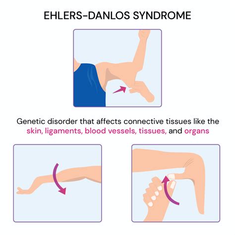 23 Signs You Grew Up With Ehlers-danlos Syndrome [2024]