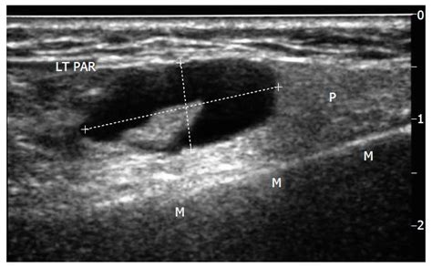 Biopsy of parotid masses: Review of current techniques