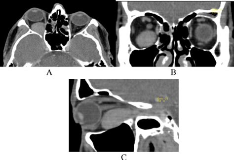 Contrast enhanced CT scan of the orbit (A) axial, (B) coronal and (C ...