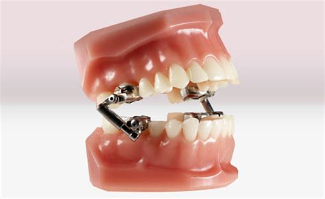 Type of orthodontics appliances - Suncreek Orthodontics in Allen Texas | Affordable Braces ...