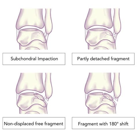 Talar Dome Injury Management For Foot | East Coast Podiatry