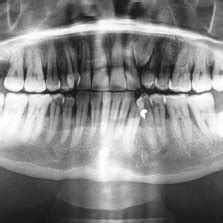 Frequency of vertical position of impacted maxillary canine | Download Scientific Diagram