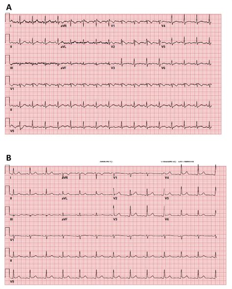 Normal Ecg Vs Heart Attack Ecg