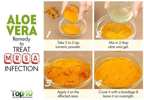 How to Cure a MRSA Infection Naturally | Top 10 Home Remedies