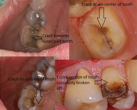 Do amalgams fracture teeth more than composite? - Bauer Smiles