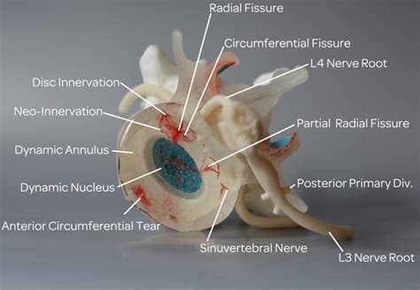 Patients with Work-Related Chronic Low Back Pain Show More Degenerative Changes on MRI, Study Finds